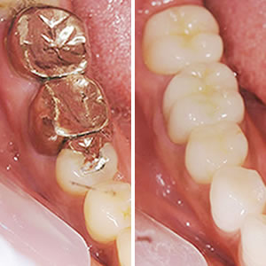 短期集中治療・フルマウス治療