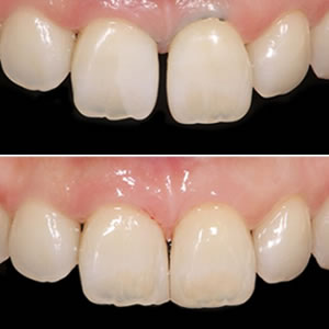 なるべく削らない治療