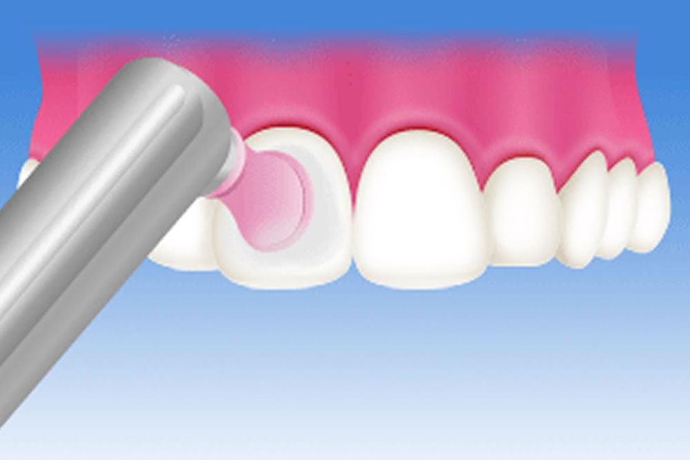 歯磨き指導(TBI)