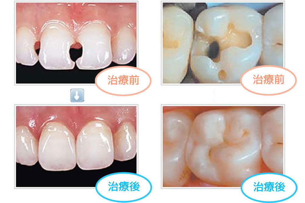 MTAによる覆髄処置