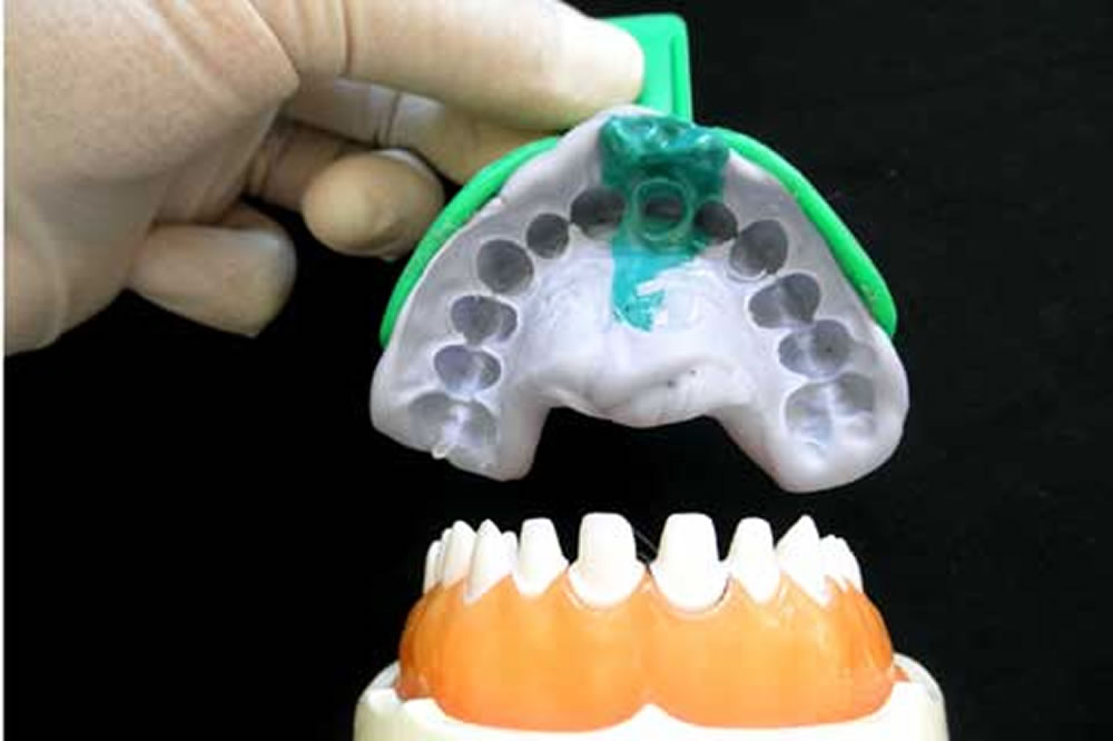 シリコンでの精密な型取り