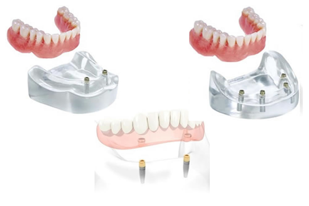 インプラントオーバーデンチャー"