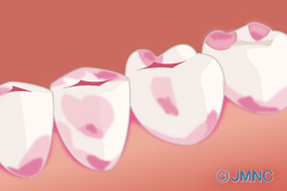 拡大視野で精密な切削