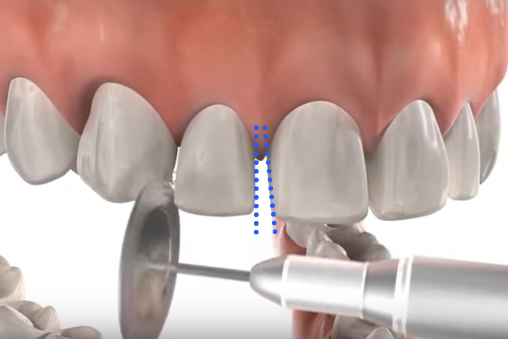 IPR法(歯幅の縮小)