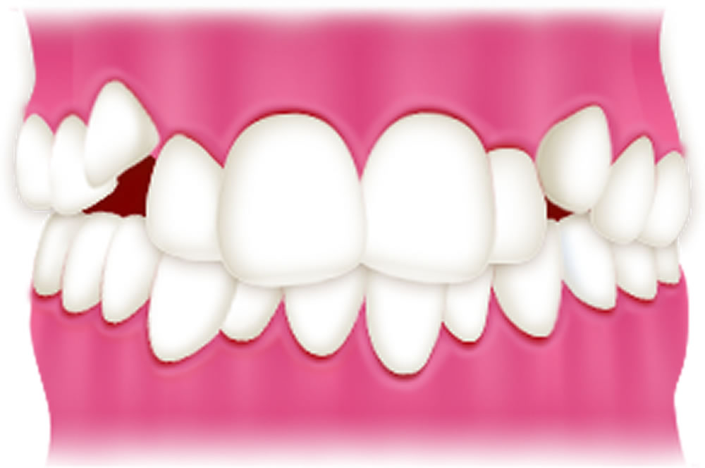 叢生(ガタガタの歯並び)