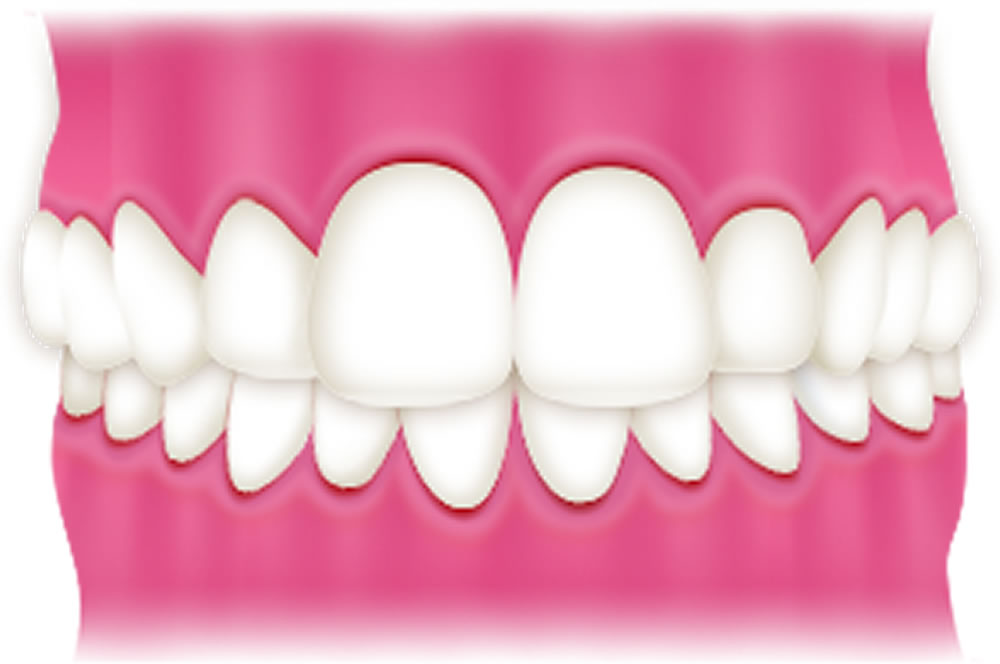 過蓋咬合(咬み合わせが深い))