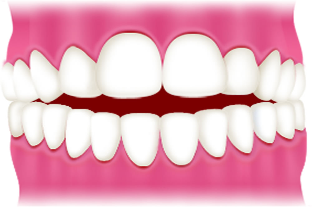 開咬(前歯に隙間ができる)