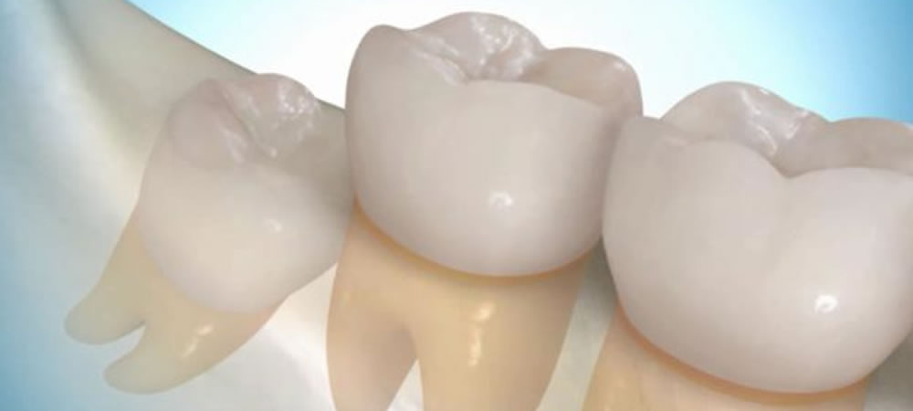 親知らずの抜歯