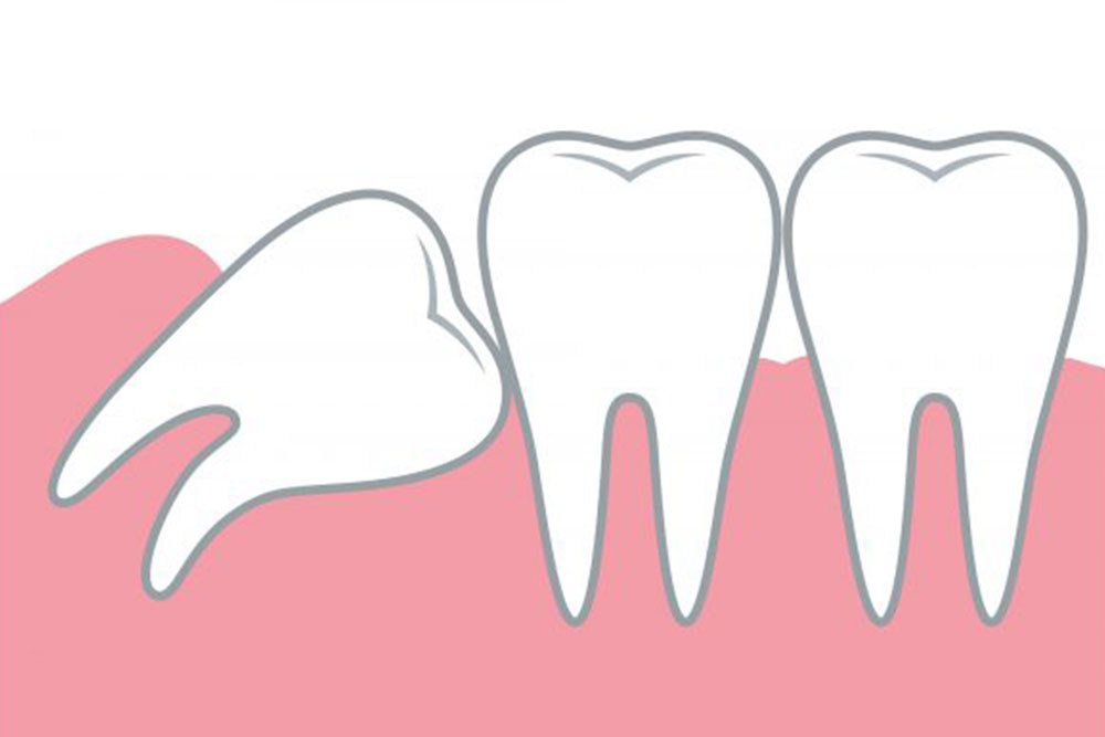 歯並びが悪くなる可能性がある